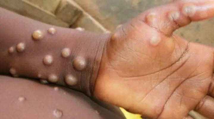 SP: Primeiro caso de varíola dos macacos é confirmado no Brasil