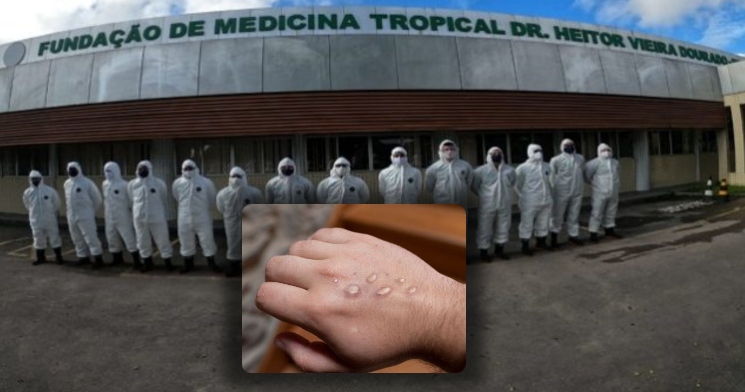 Primeiro caso suspeito de varíola dos macacos no AM é investigado em Manaus